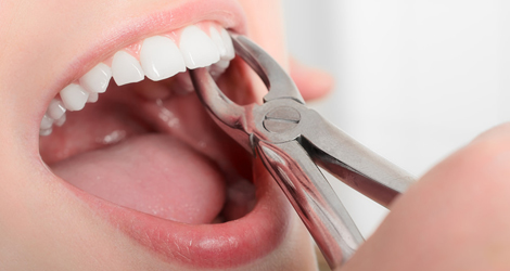 Dental-Extractions