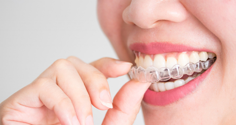 Invisalign Mississauga