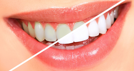 Teeth-Whitening