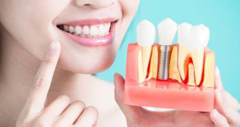 Dental Implants