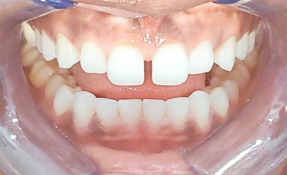 [TN640x400]-VOI30923677_closeup_anterior