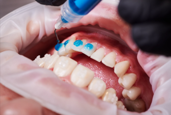 professional teeth whitening in Mississauga