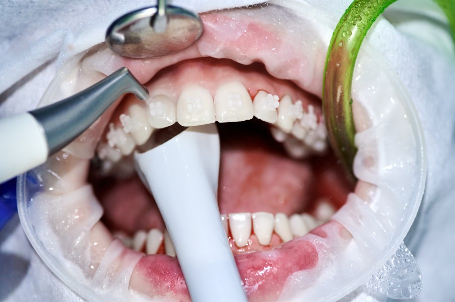 professional teeth whitening