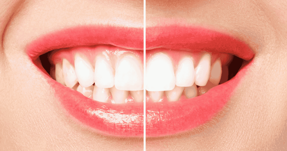 Teeth Whitening Mississauga