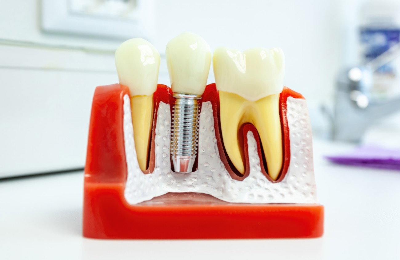 Dental Implant Cost Mississauga