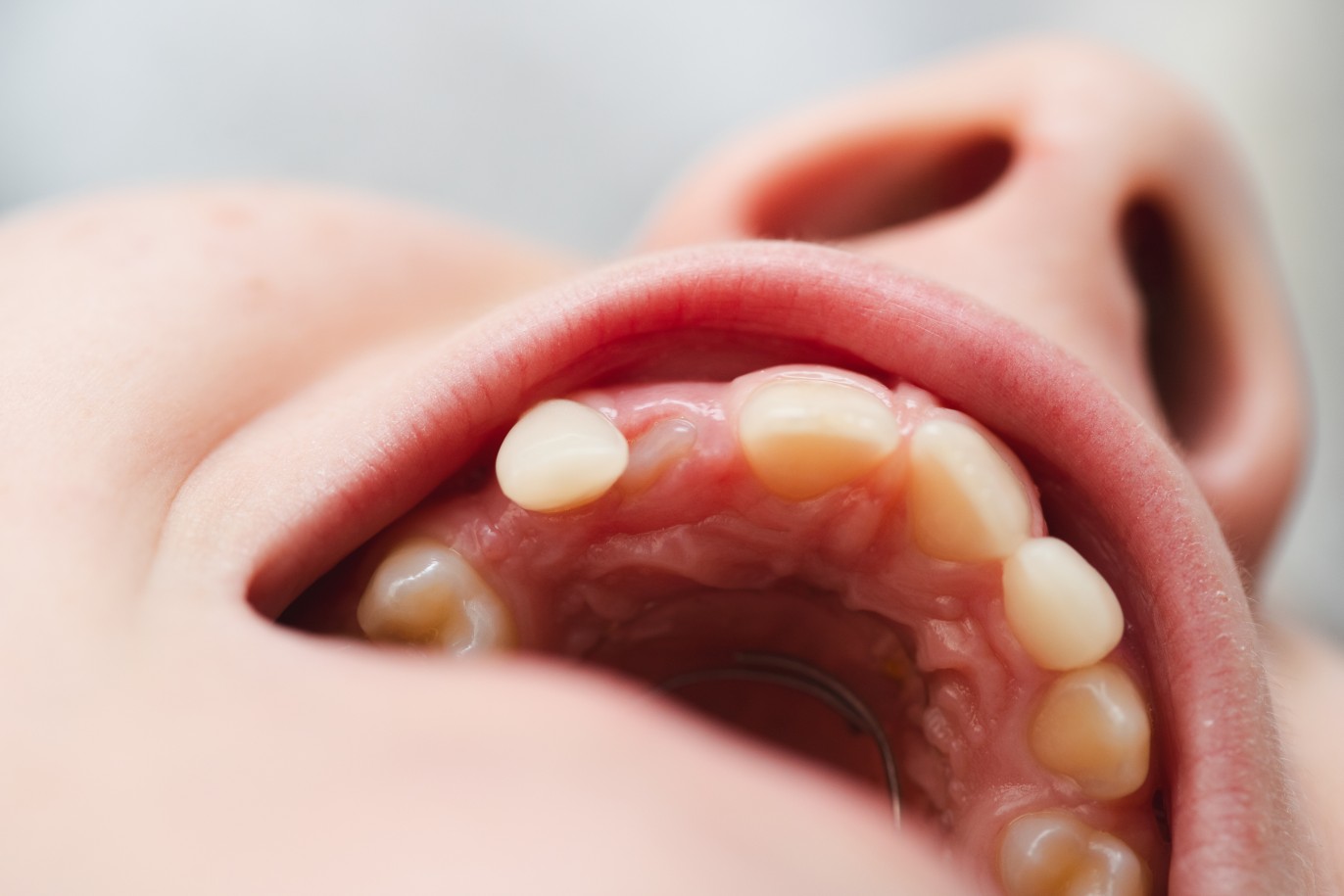 Tooth Extraction Services