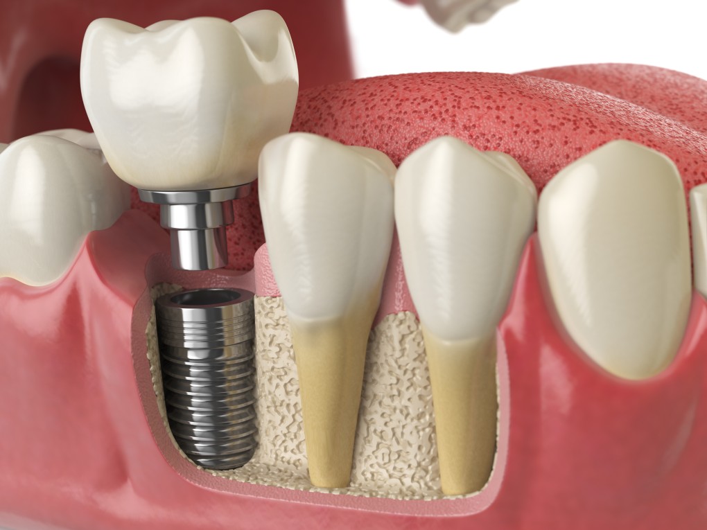 Dental Implant Costs