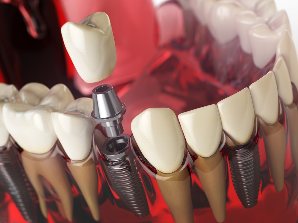 Dental Implant Services
