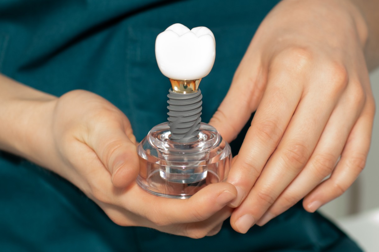 Dental implant cost in Mississauga
