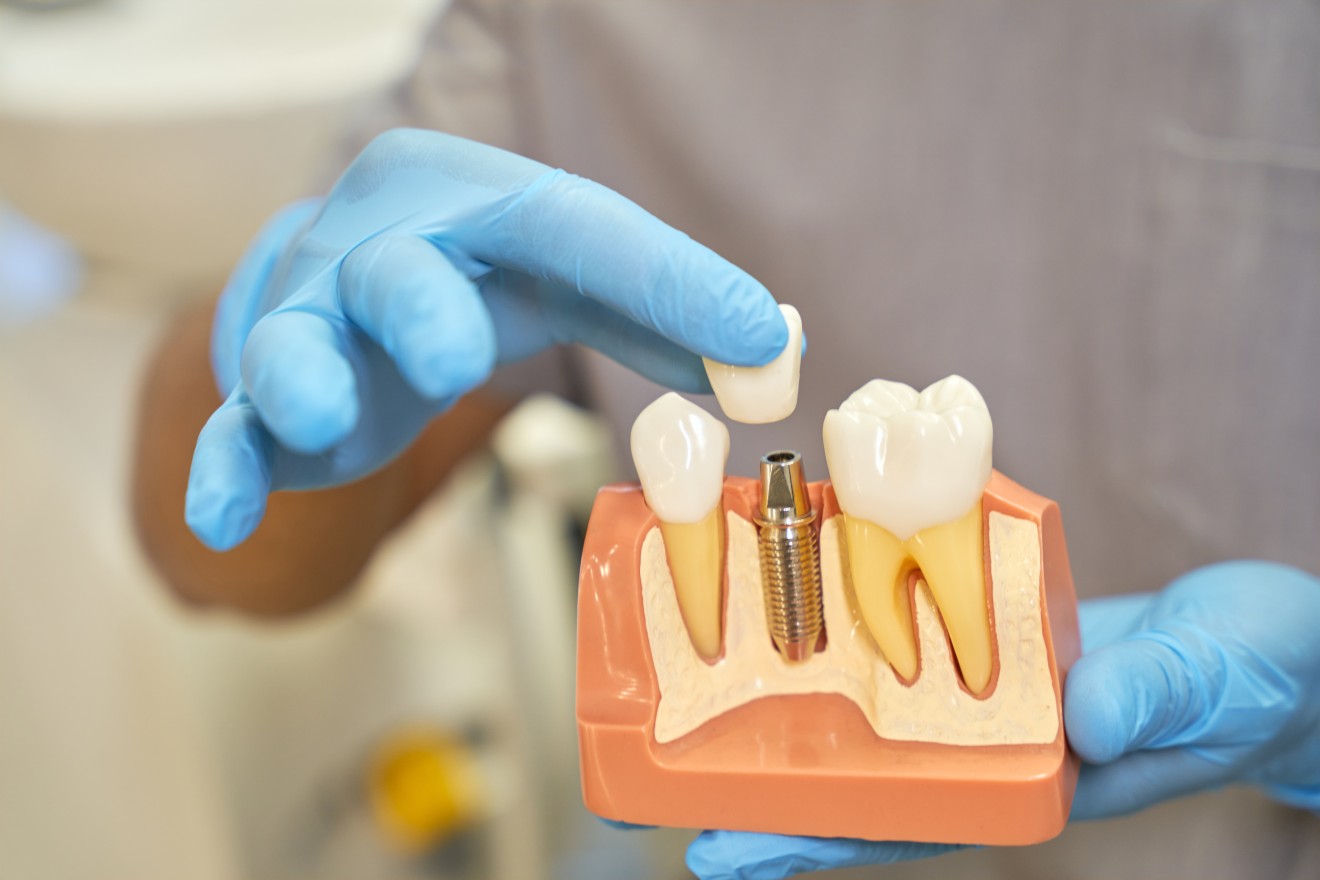 Dental Implants in Mississauga