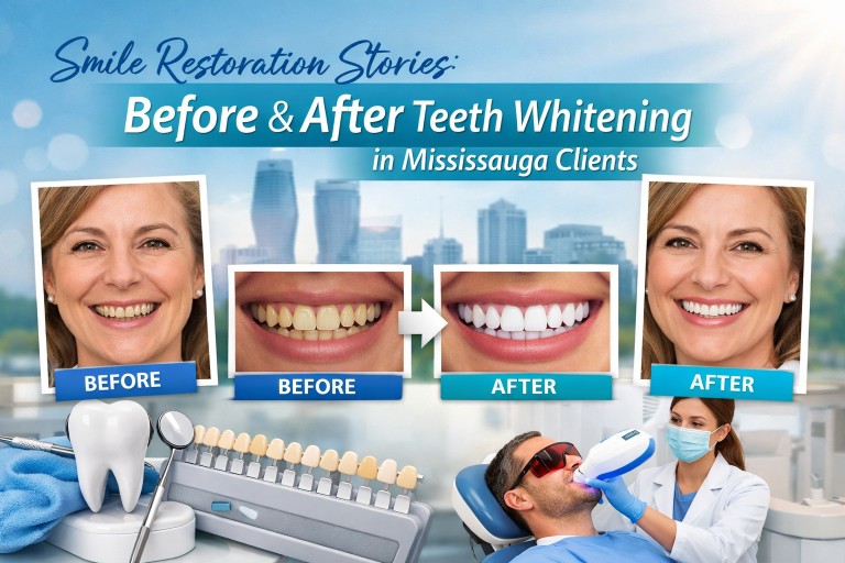 teeth whitening in Mississauga