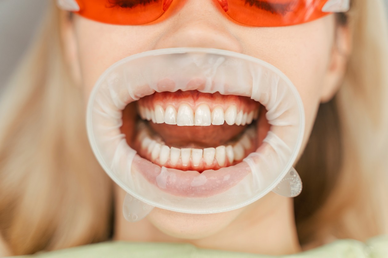 teeth whitening in Mississauga