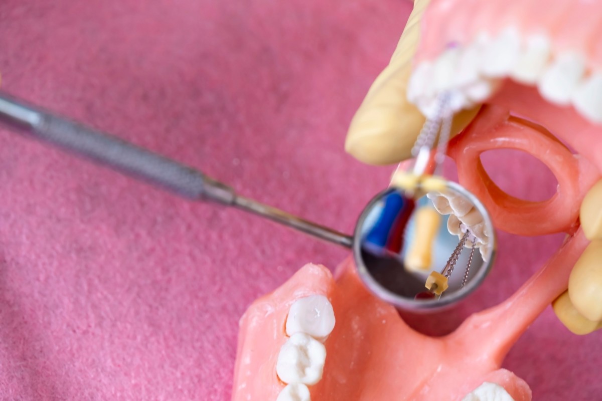 root canal treatment cost